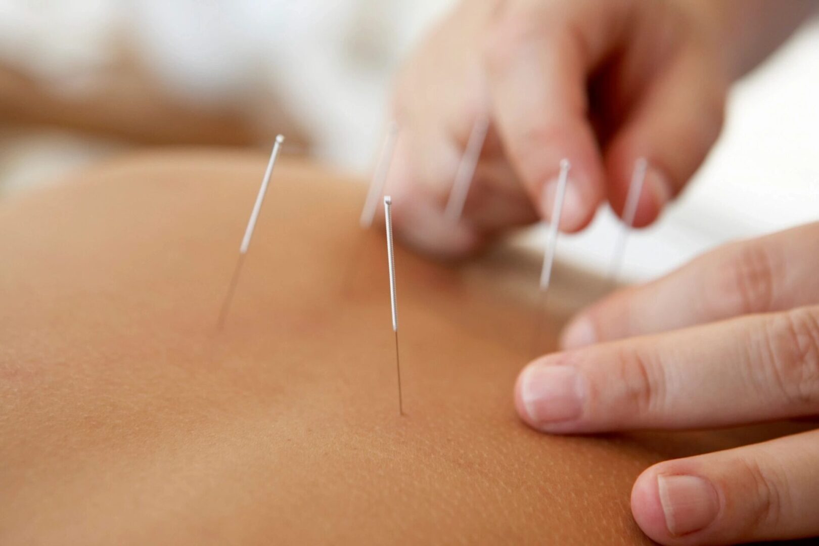 A person is using acupuncture needles to treat a patient.