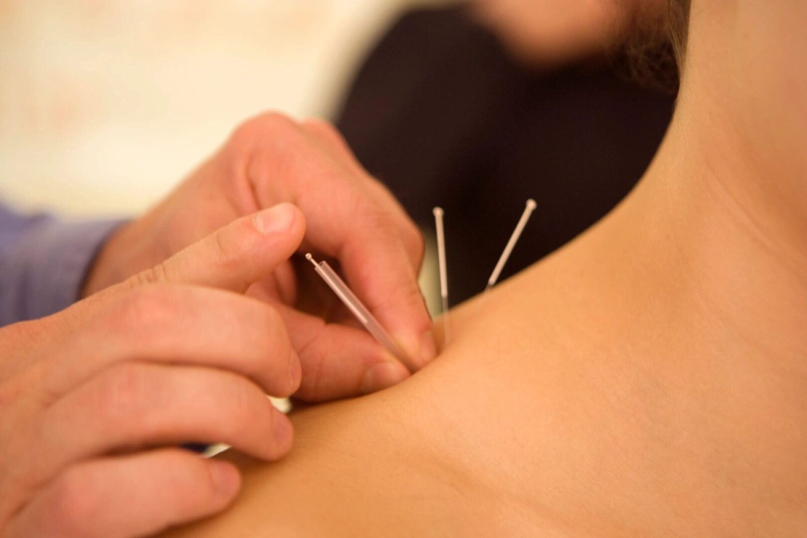A person is using acupuncture needles on the back of another person.