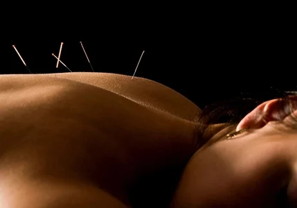 A woman is laying down with acupuncture needles in her back.